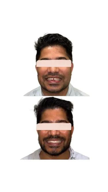 Caso clínico de dentisteria