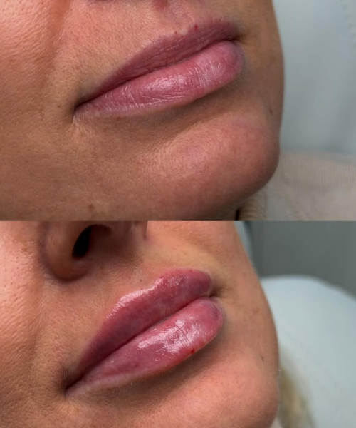 Harmonização Orofacial (11)