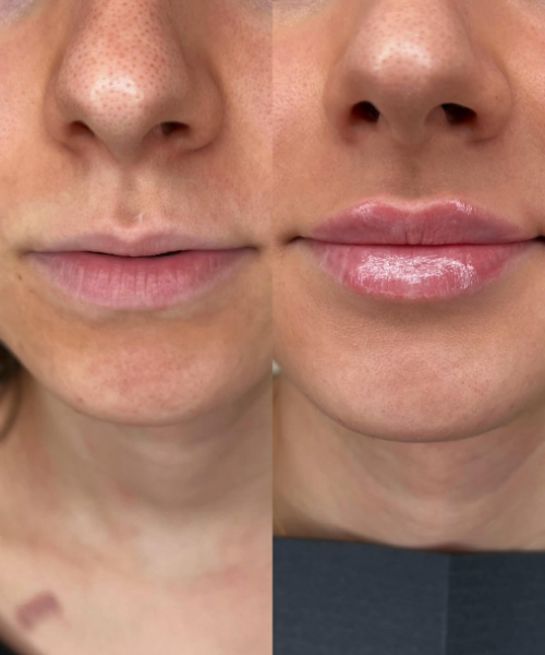 Harmonização Orofacial (12)