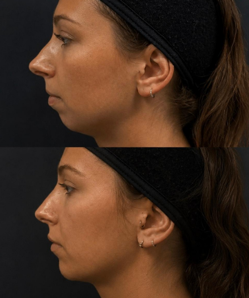 Harmonização Orofacial (15)