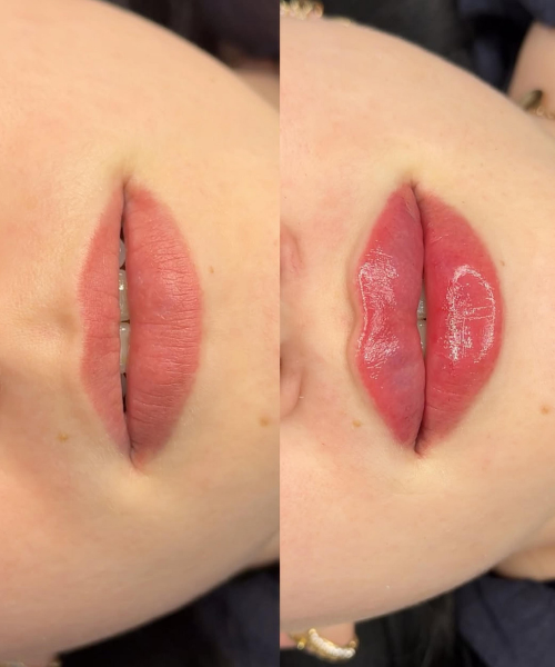 Harmonização Orofacial (18)