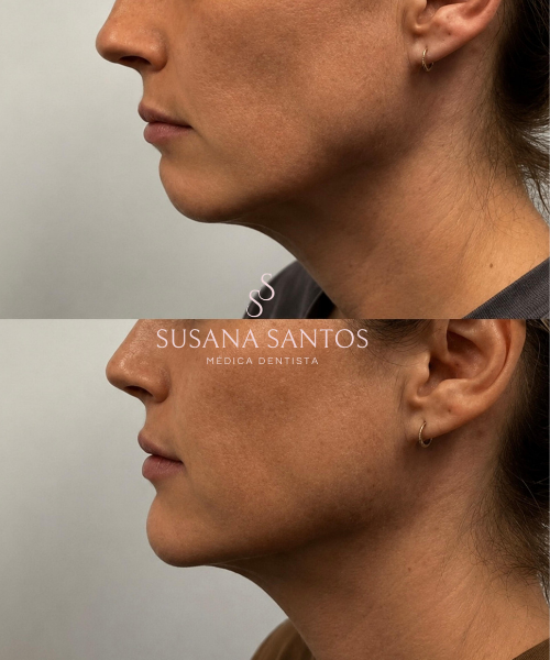 Harmonização Orofacial (2)