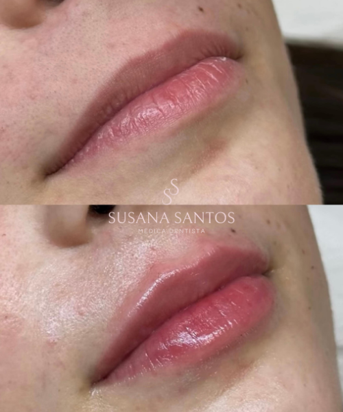 Harmonização Orofacial (8)