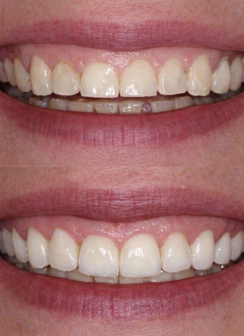 Caso clínico de dentisteria