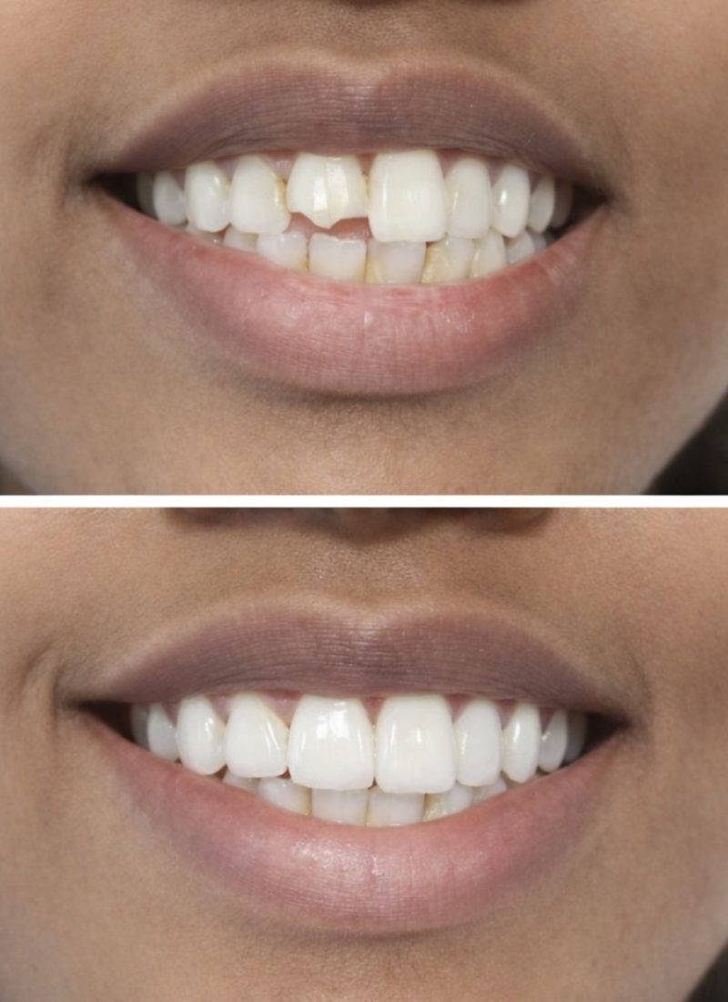 Caso clínico de dentisteria